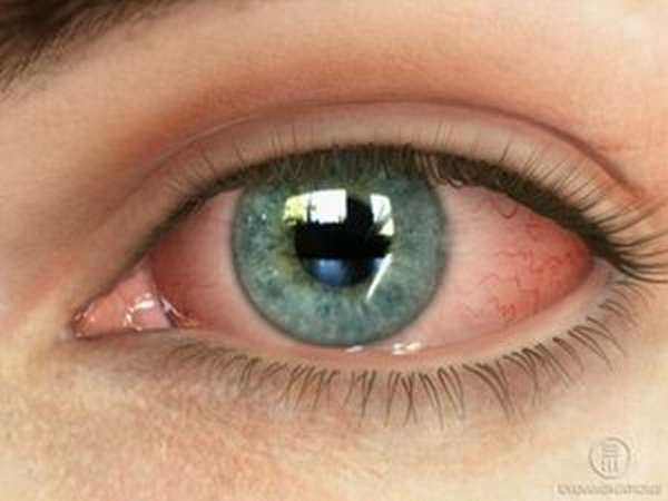 Светобоязнь глаз — каковы причины данного недуга? Причины и терапия гелиофобии